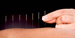 CCJC aprova regulamentação da prática de acupuntura