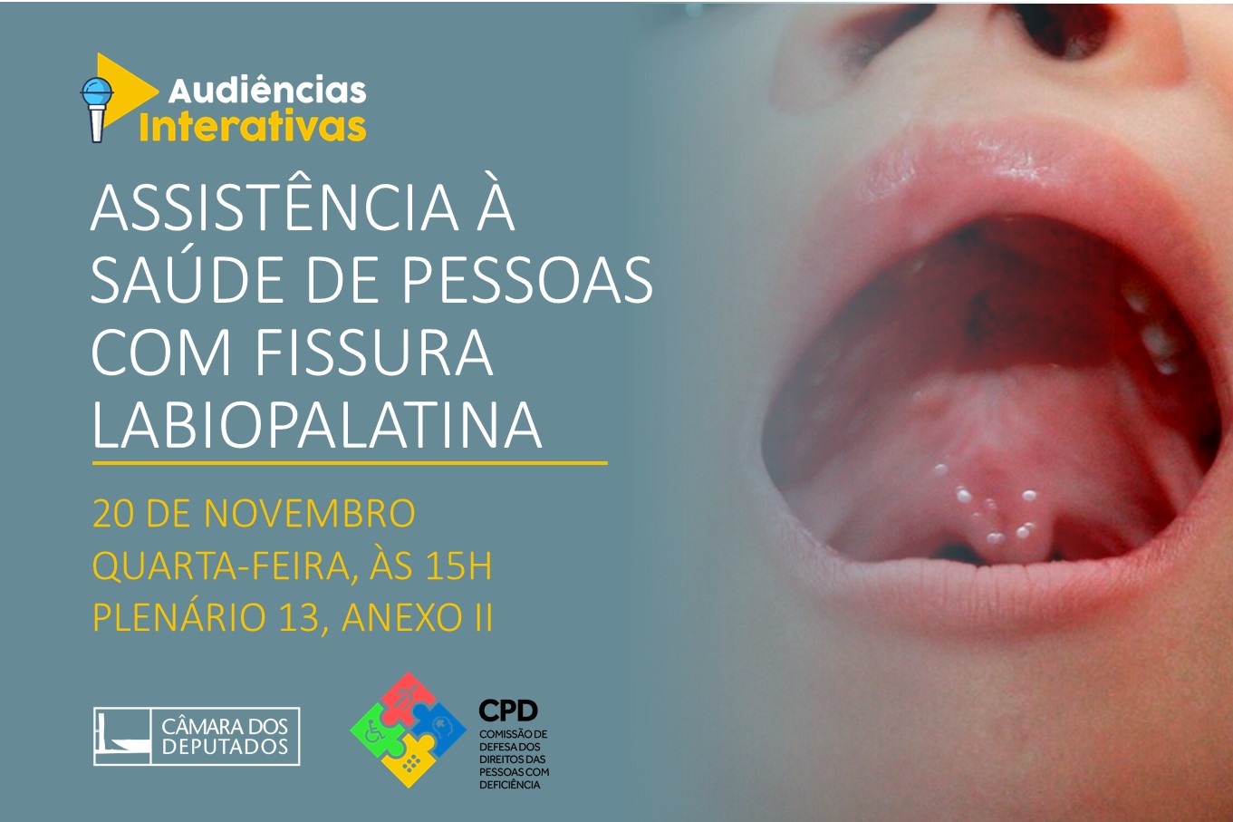 Audiência pública debaterá a Assistência à Saúde de Pessoas com Fissura Labiopalatina